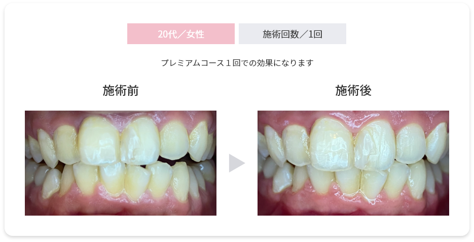20代女性・施術回数１回／プレミアムコース１回での効果になります