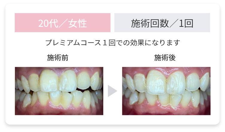 20代女性・施術回数１回／プレミアムコース１回での効果になります